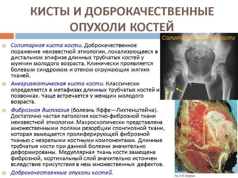 КИСТЫ И ДОБРОКАЧЕСТВЕННЫЕ ОПУХОЛИ КОСТЕЙ Солитарная киста кости. Доброкачественное поражение неизвестной этиологии, локализующееся в